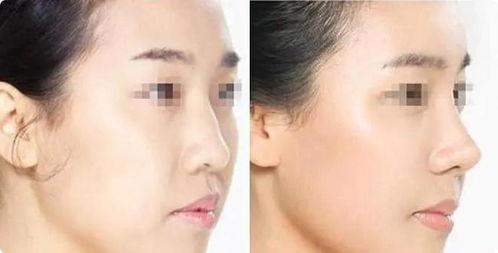 鼻子整形视频,美丽蜕变全过程