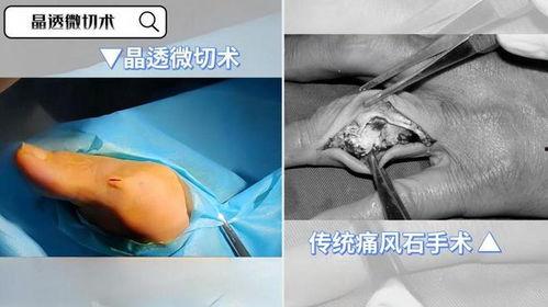 痛风石视频,揭秘痛风的“隐形炸弹”